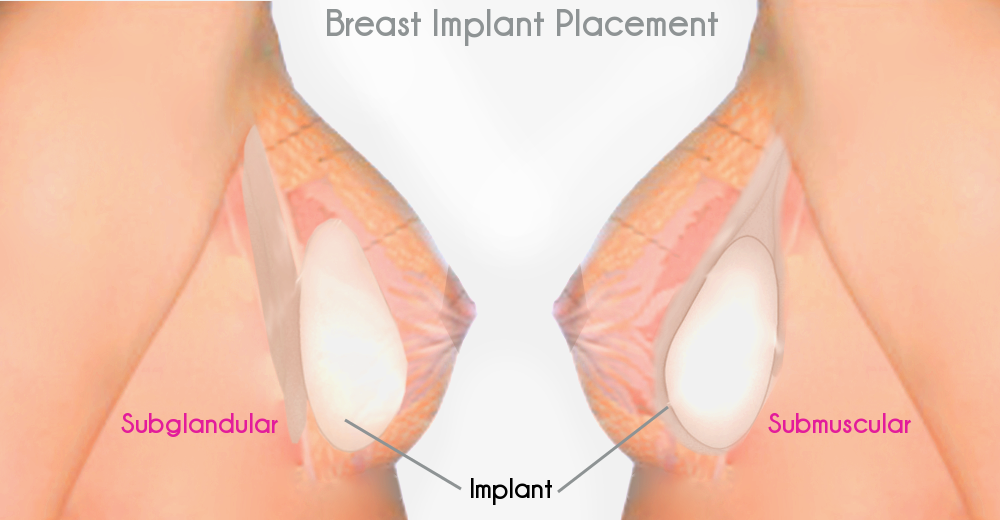 breast-implant-remplace1
